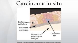 Carcinoma in situ [upl. by Web]