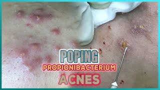 Big Cystic Acne Blackheads Extraction Blackheads amp Milia Whiteheads Removal Pimple Popping [upl. by Ragan]