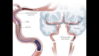 Endovascular thrombectomy with or without intravenous alteplase in acute stroke DIRECTMT [upl. by Ivan]