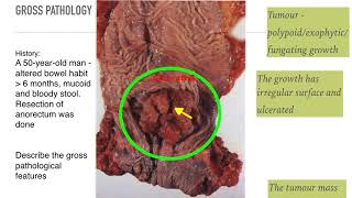 Pathology of Colorectal Cancer Adenocarcinoma [upl. by Kreiker940]