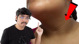 Dark Neck Removal in TELUGU  Acanthosis Nigricans [upl. by Randolph]