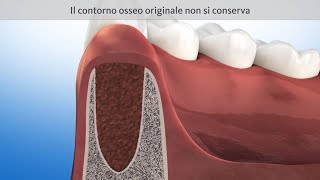 Estrazione del dente e guarigione senza preservazione della cresta [upl. by Llerdnod]