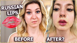 MY RUSSIAN LIP FILLER EXPERIENCE [upl. by Rodama]