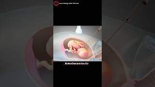 What is an amniocentesis  Amniotic fluid check up [upl. by Aratahc134]