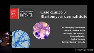 Caso clínico  Infección por Blastomyces Dermatitidis Microbiología [upl. by Harwill]