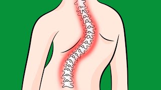 How to Fix Idiopathic Scoliosis Naturally [upl. by Eilime727]