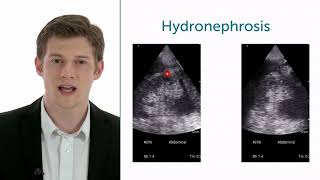 How To Evaluate Hydronephrosis In Point of Care Ultrasound [upl. by Dianuj]