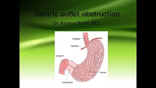 Gastric outlet obstruction [upl. by Euqinamod]