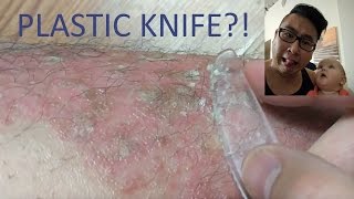 PSORIASIS MAINTENANCE WITH A PLASTIC KNIFE [upl. by Chapel495]