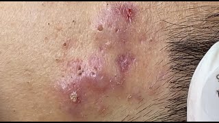 Hematoma Inflammation Acne HoangMySpa87 [upl. by Iams]