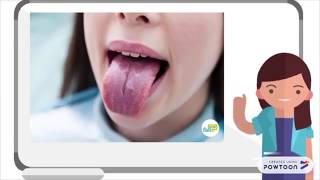 ORAL ALLERGY SYNDROME  Why and How it Happens [upl. by Troyes]