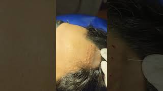 Steroid injection for Alopecia Areata [upl. by Zora]