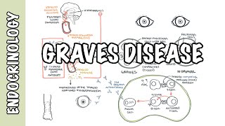 Graves Disease  Overview causes pathophysiology investigations and treatment [upl. by Purcell]