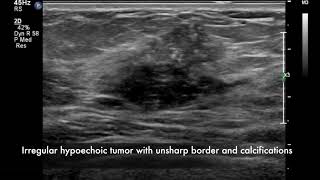 Breast ultrasound  cancer [upl. by Oremo36]