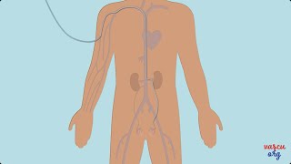 Traitement des varicocèles par embolisation  Chirurgie vasculaire miniinvasive [upl. by Ivets]