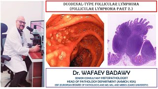 DUODENAL TYPE FOLLICULAR LYMPHOMA BY DR WAFAEY BADAWY [upl. by Esiuqram]