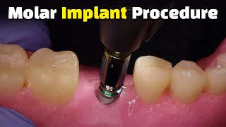 Step by Step Dental Implant Procedure  Back Molar [upl. by Nnaeerb592]