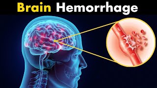 What Happens in Brain hemorrhage  Symptoms Causes and Treatment 3d animation [upl. by Etteyafal666]