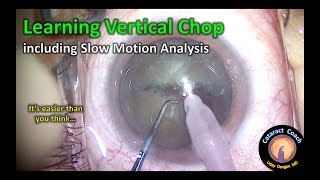 learning vertical phaco chop cataract surgery [upl. by Simmie]