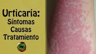 Urticaria Síntomas causas tratamiento y pronóstico [upl. by Kciredorb]