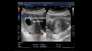 A Pregnancy of 7 weeks Ultrasound Findings [upl. by Graces]