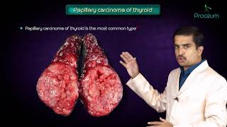 Thyroid neoplasms part 1  Papillary carcinoma of thyroid   Endocrine pathology [upl. by Seyer]