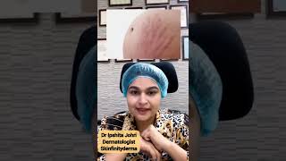 When Should you Get Stretch Marks Treatment Stretch Marks Treatment [upl. by Nnyliram]