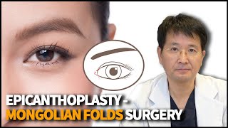 Epicanthoplasty  Eye Surgery that modifies the Epicanthal Folds [upl. by Luann]