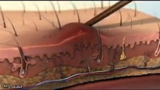 inflammatory reaction in 3D animation [upl. by Yeargain964]