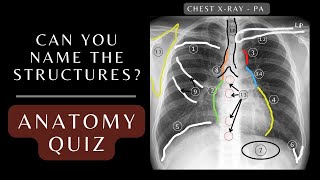 Chest Xray Anatomy Quiz Questions and Answers  Chest Xray Anatomy xray respiratory [upl. by Eleynad]