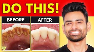 How to Remove Dental Plaque amp Prevent Cavities [upl. by Lekkim]