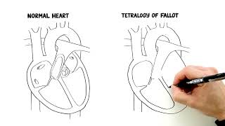 What is Tetralogy of Fallot [upl. by Mota]