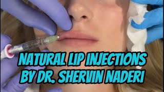 Natural Lip Injections with Juvederm Volbella [upl. by Marleah]