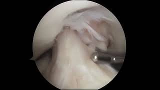 Torn Meniscus Arthroscopic Surgery [upl. by Negrom]