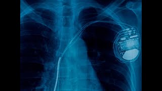 Automatic Implantable CardioverterDefibrillator AICD Explained CureU Healthcare cureuhealthcare [upl. by Jasmina279]