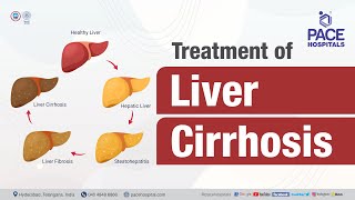 Treatment for Liver Cirrhosis  PACE Hospitals Shortvideo livercirrhosis [upl. by Aiduan]