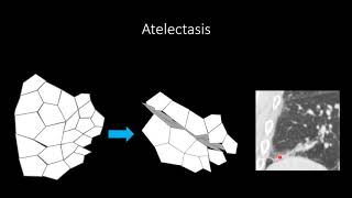 Atelectasis [upl. by Yeznil]