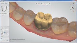 Full anatomical crown on TRIOS® scan [upl. by Odnumde]