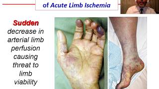 Acute Ischemia  OVERVIEW [upl. by Anialem862]