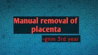 Manual removal of placenta note gnm 3rd year [upl. by Eniamret]