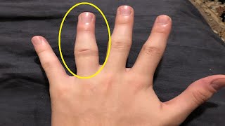 how to get rid of a jammed finger naturally [upl. by Popelka]