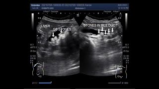 Cholelithiasis associated with Choledocholithiasis [upl. by Danete720]