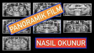 Panoramik Film Nasıl Okunur [upl. by Anastice]