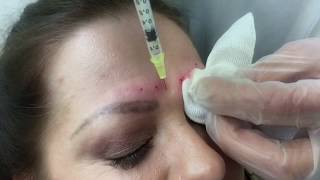 Faltenbehandlung Zornesfalte Botox Dr Khorram Stuttgart [upl. by Oballa]