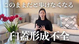 その股関節の痛み放置しないで！臼蓋形成不全と診断されたので詳しく説明します [upl. by Lamphere946]