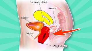 ➜ UTERINE PROLAPSE Treatment At Home ➜ 5 Easy Exercises [upl. by Wetzel340]