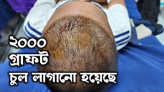 টাক মাথায় ২০০০ গ্রাফট চুল প্রতিস্থাপন  Hair Transplant Bangladesh [upl. by Merlina704]