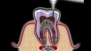 Wurzelbehandlung beim Zahnarzt [upl. by Htaeh]