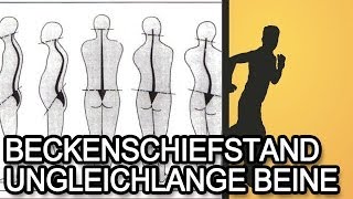 Beckenschiefstand und ungleichlange Beine  Ursache amp Symptome [upl. by Akerue]