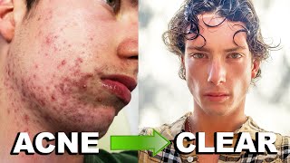 MY ACCUTANE JOURNEY  Clearing 6 Years of Acne Big Acne Transformation [upl. by Asiulairam341]